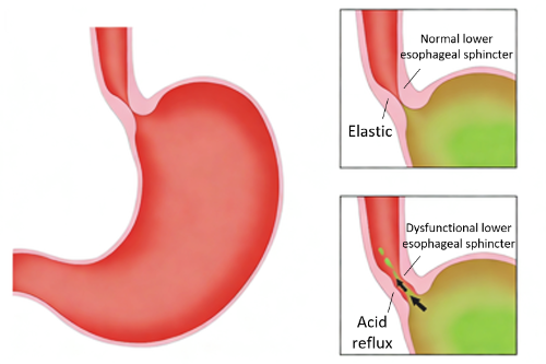 GERD-Diagnostik leicht gemacht: Von der Endoskopie zu nicht-invasiven Speicheltests