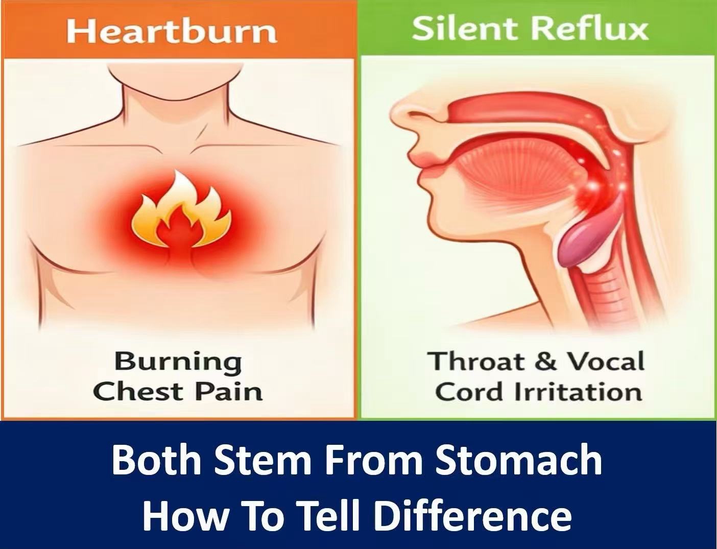 Sodbrennen vs. stiller Reflux: Wie erkennt man den Unterschied?